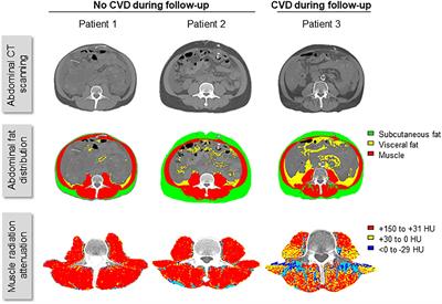 Non-invasive Quantification of Fat Deposits in Skeletal Muscle Predicts Cardiovascular Outcome in Kidney Failure